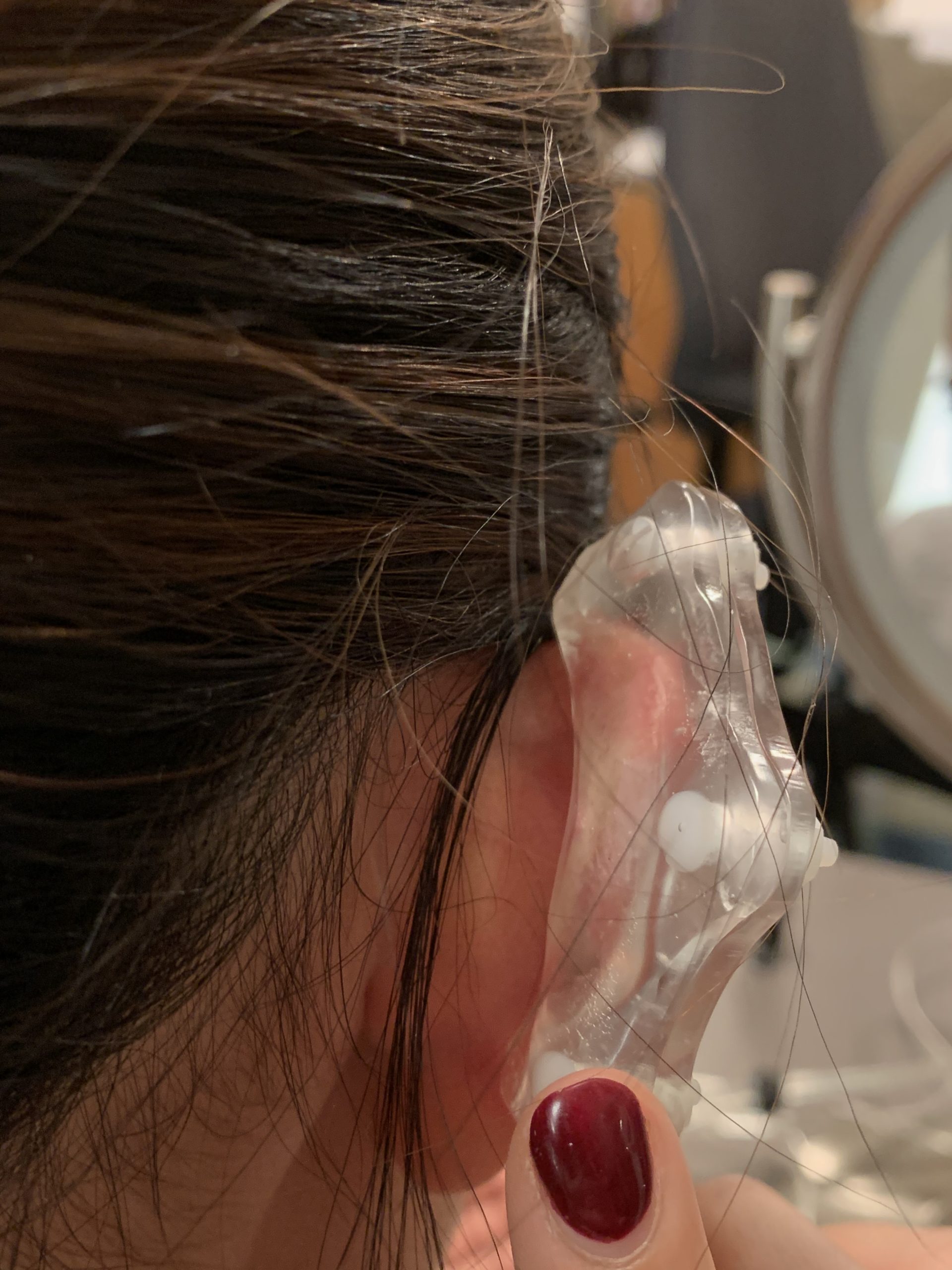 Ear Keloid Compression Clip Single Clip on Earring for Post-op Keloid  Treatment 