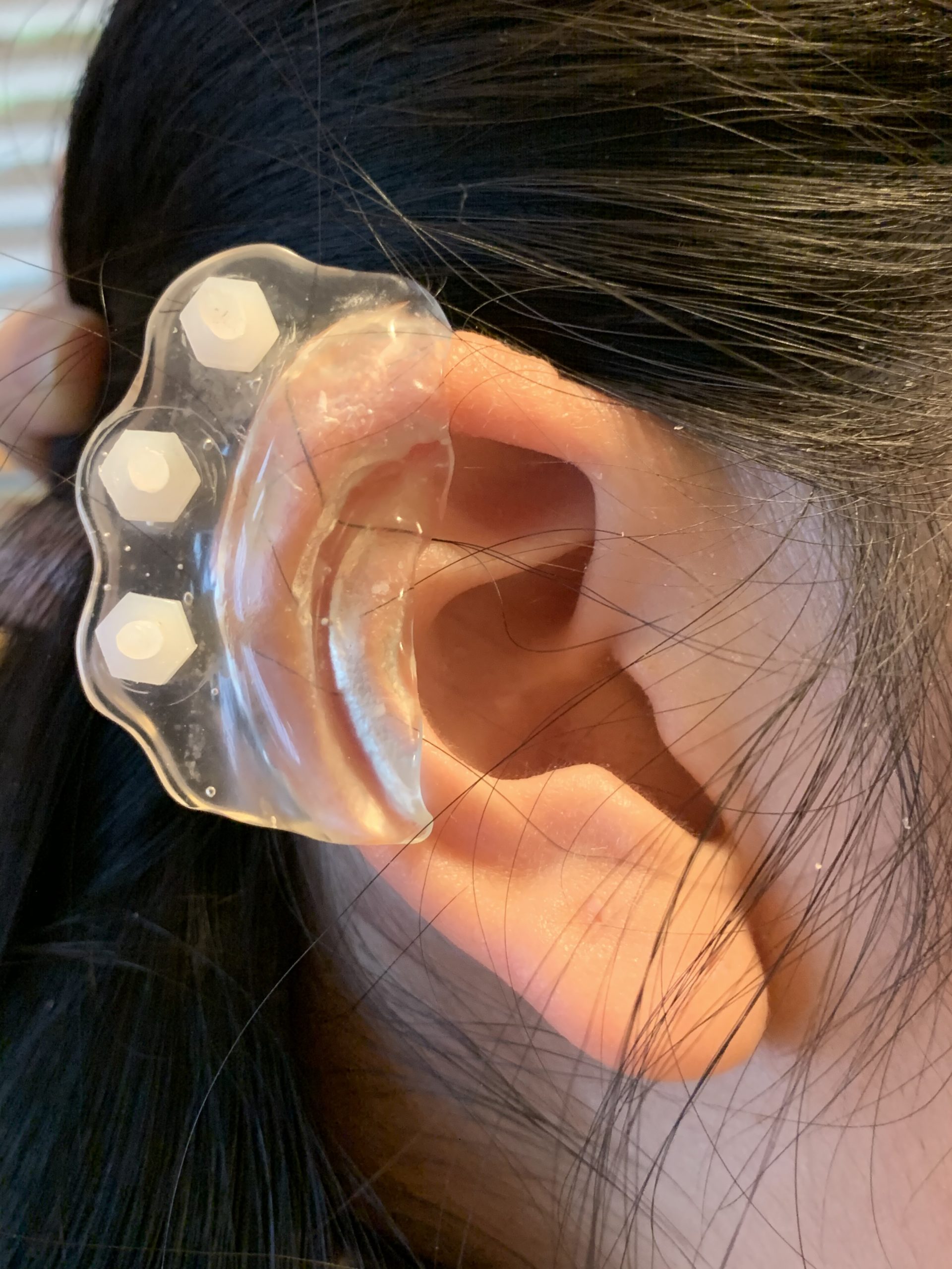 Flower Compression Pressure Keloid Clip-on Earrings