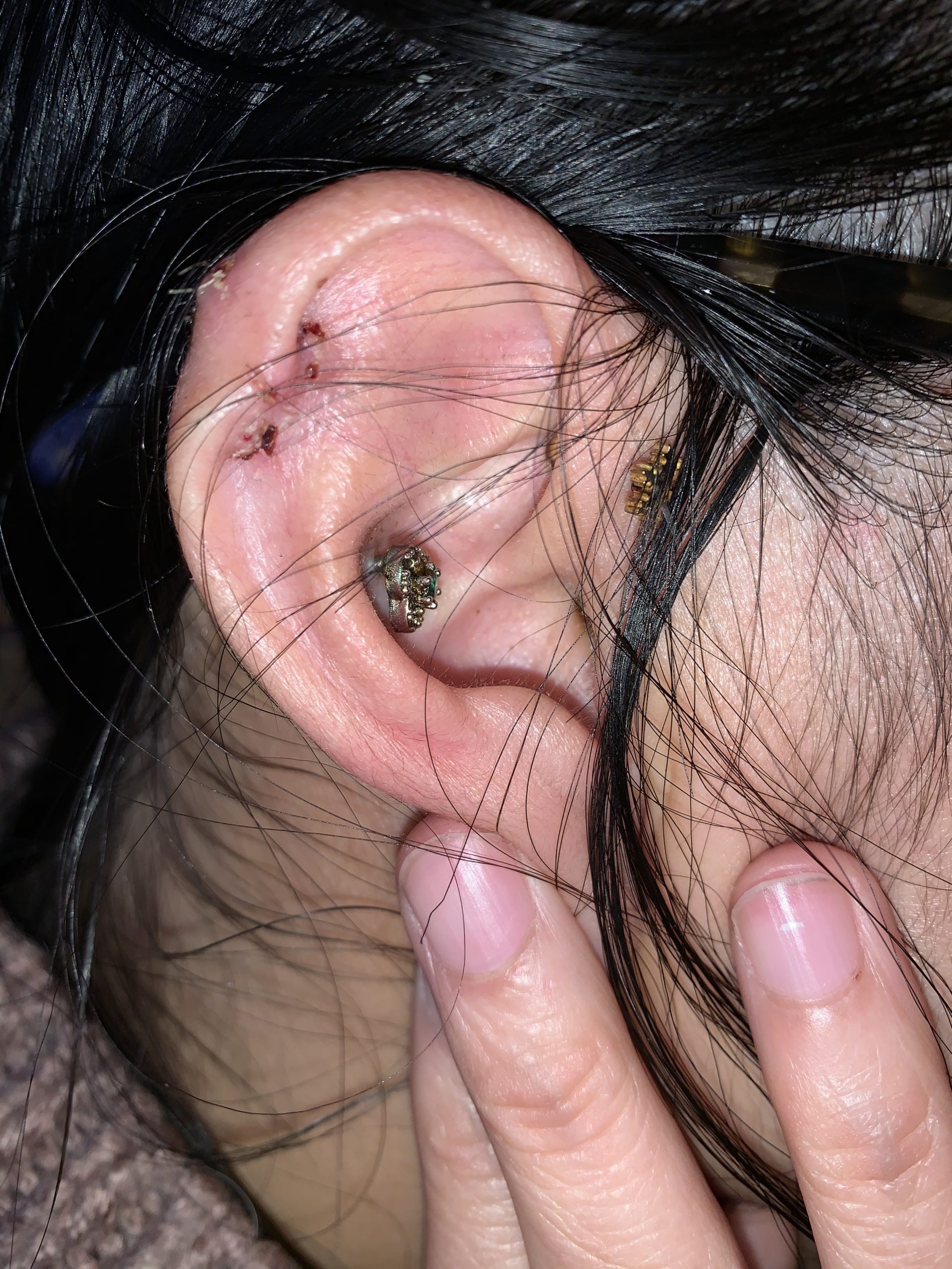 Melbourne Hand Therapy - KELOIDS & PRESSURE EARRINGS- Ear keloids