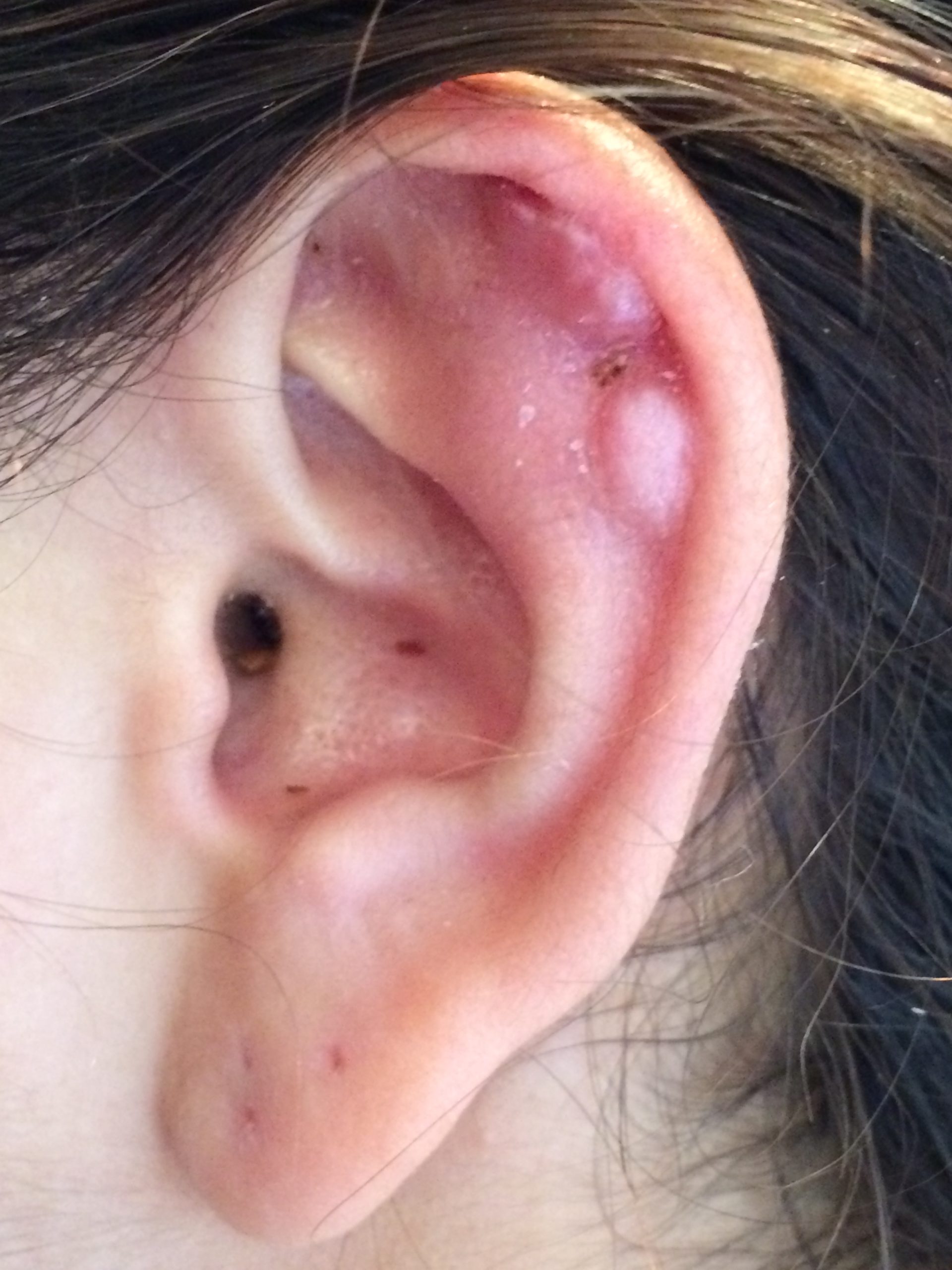 Keloid compression earrings