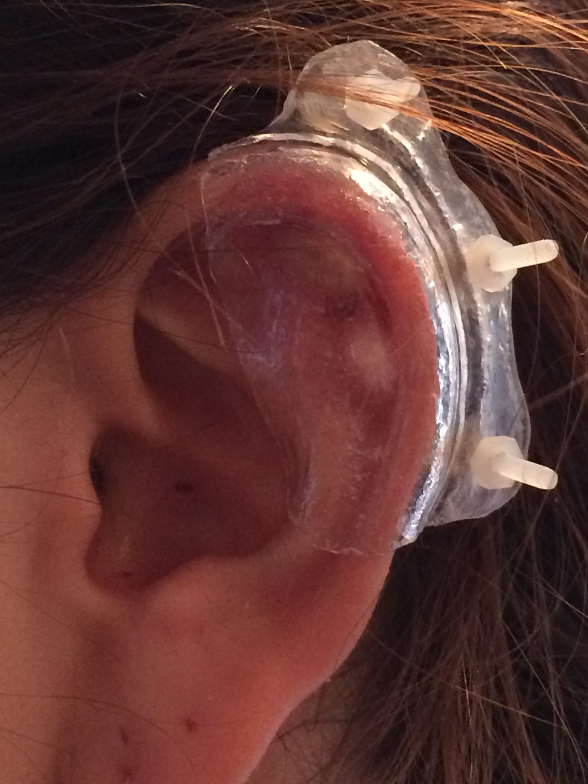 Keloid Post-Operative Pressure Earrings