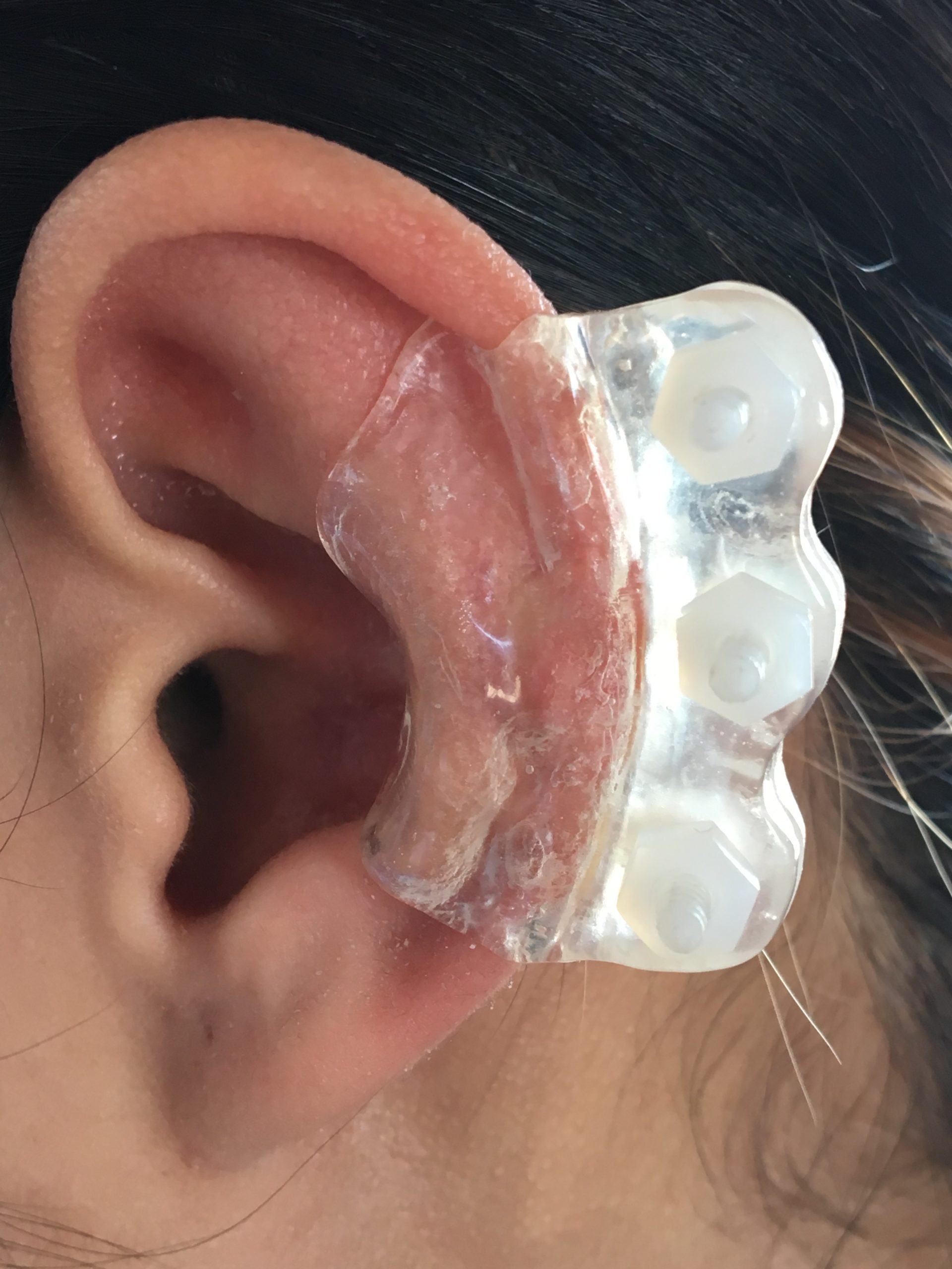 Ear Keloid Compression Plastic Discs Plastic Disc Earring for Post-op Keloid  Pressure model dogbone 