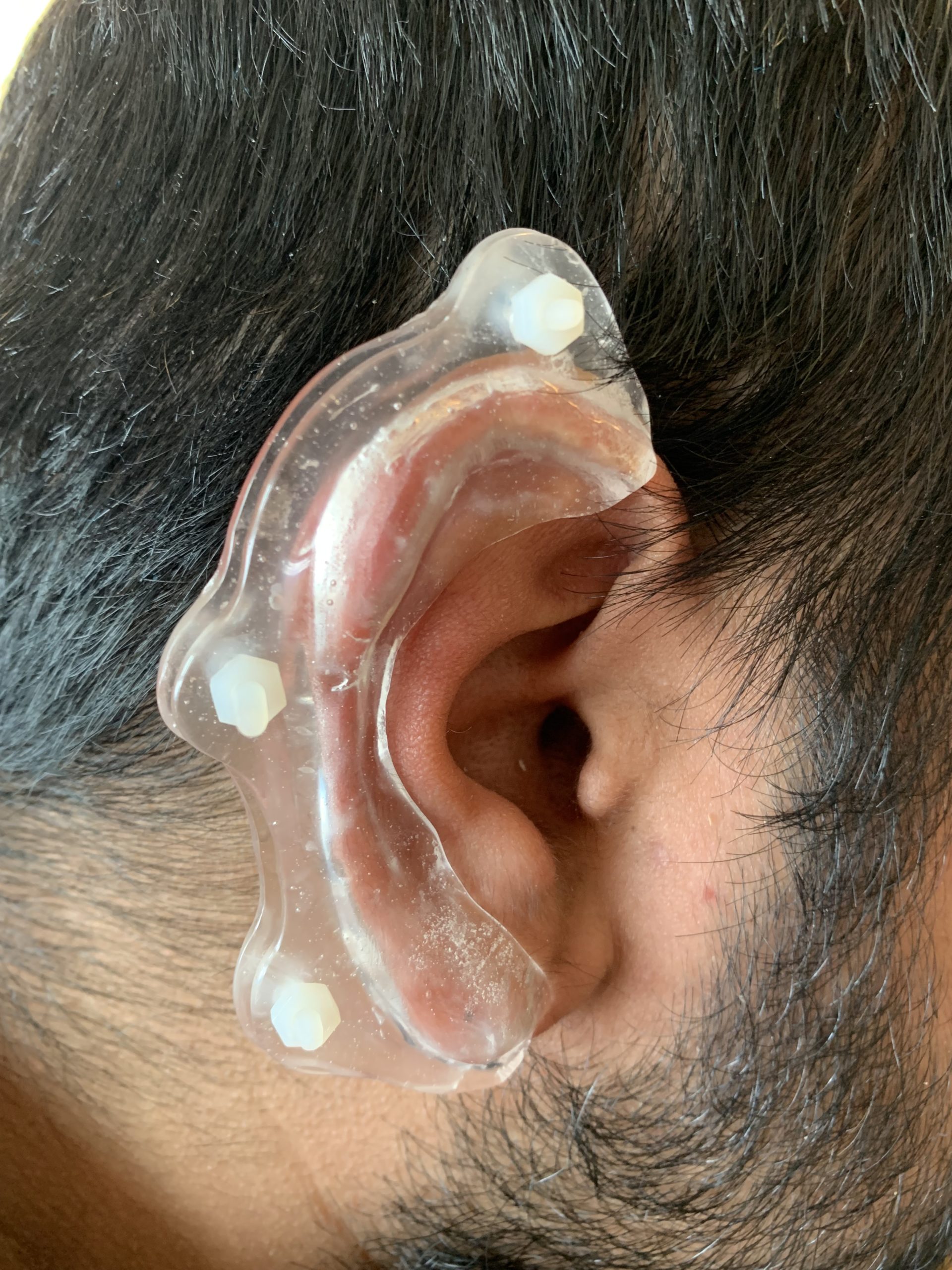 Pressure clip for sales ear keloid